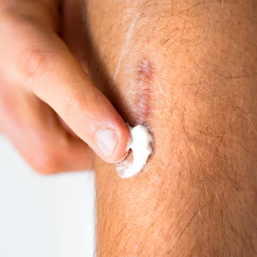 Sebkezelés okosan – lépésről lépésre a szebb gyógyulásért